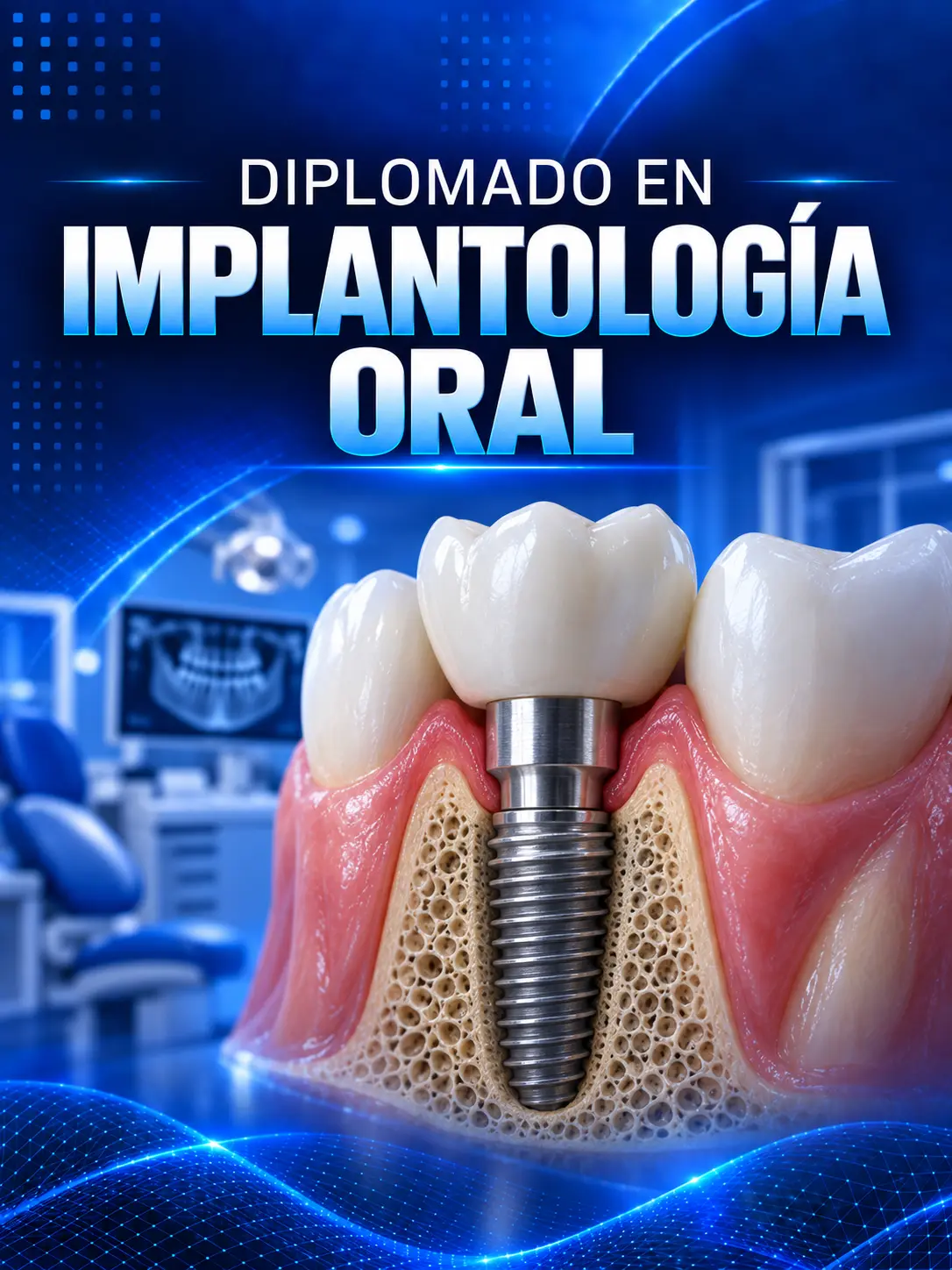 Diplomado en Implantología Oral