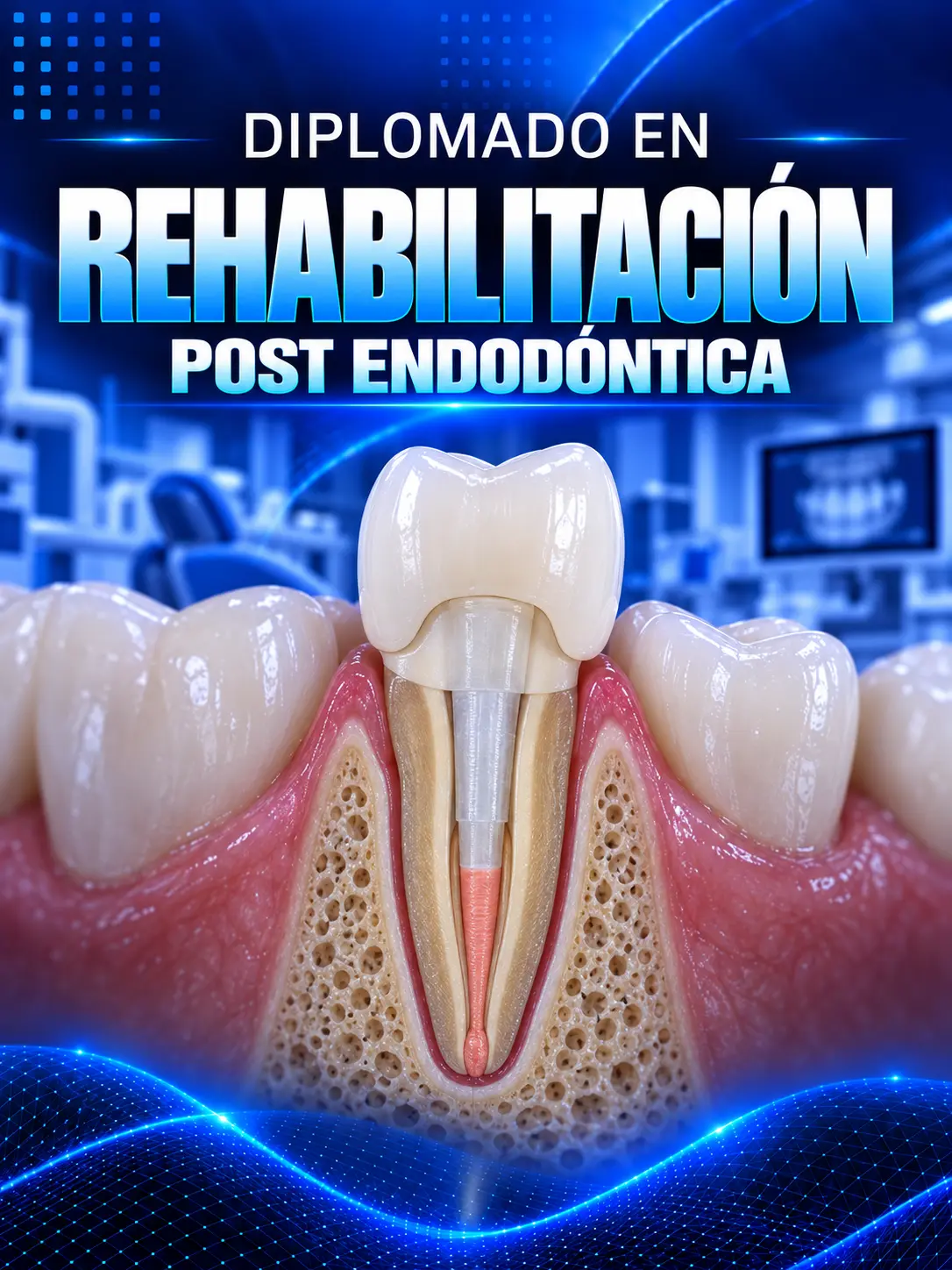 Diplomado en Rehabilitación Post Endodóntica